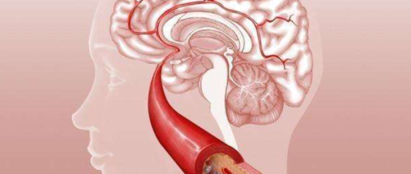 怎样防治脑血管病伤脑？