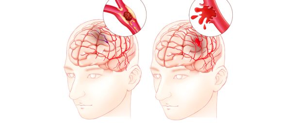 为什么脑血管会发生出血和缺血？