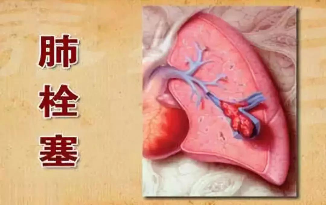 肺栓塞